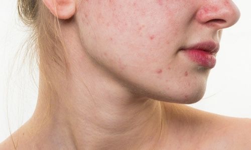 4 Pregnancy Skin Problems Plus How To Treat Them acne